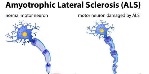 Understanding Amyotrophic Lateral Sclerosis (ALS)